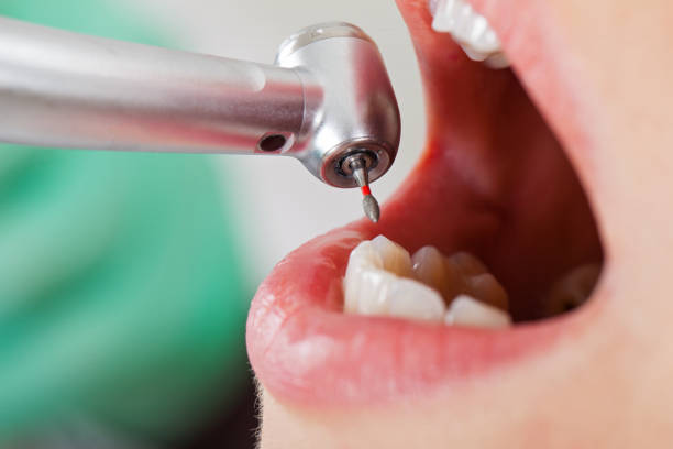 Best Chipped Tooth Repair Near Me  in Hardwick, GA